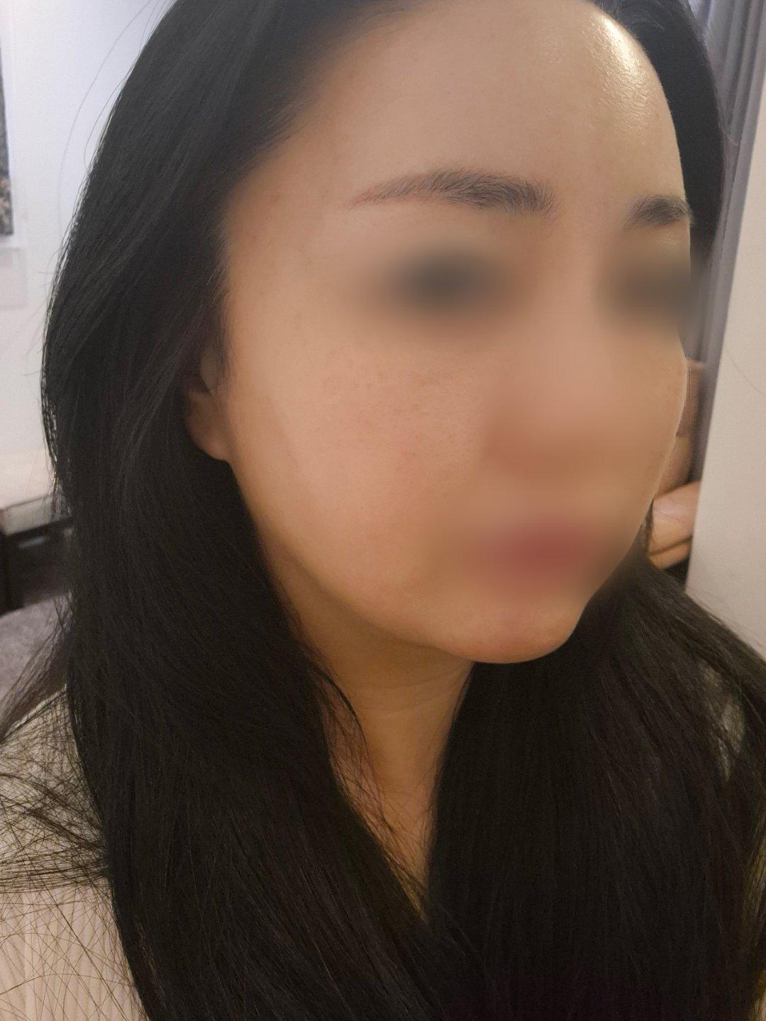 终于对眉眼和下颌下垂动手了——Ultherapy 超声提升 3