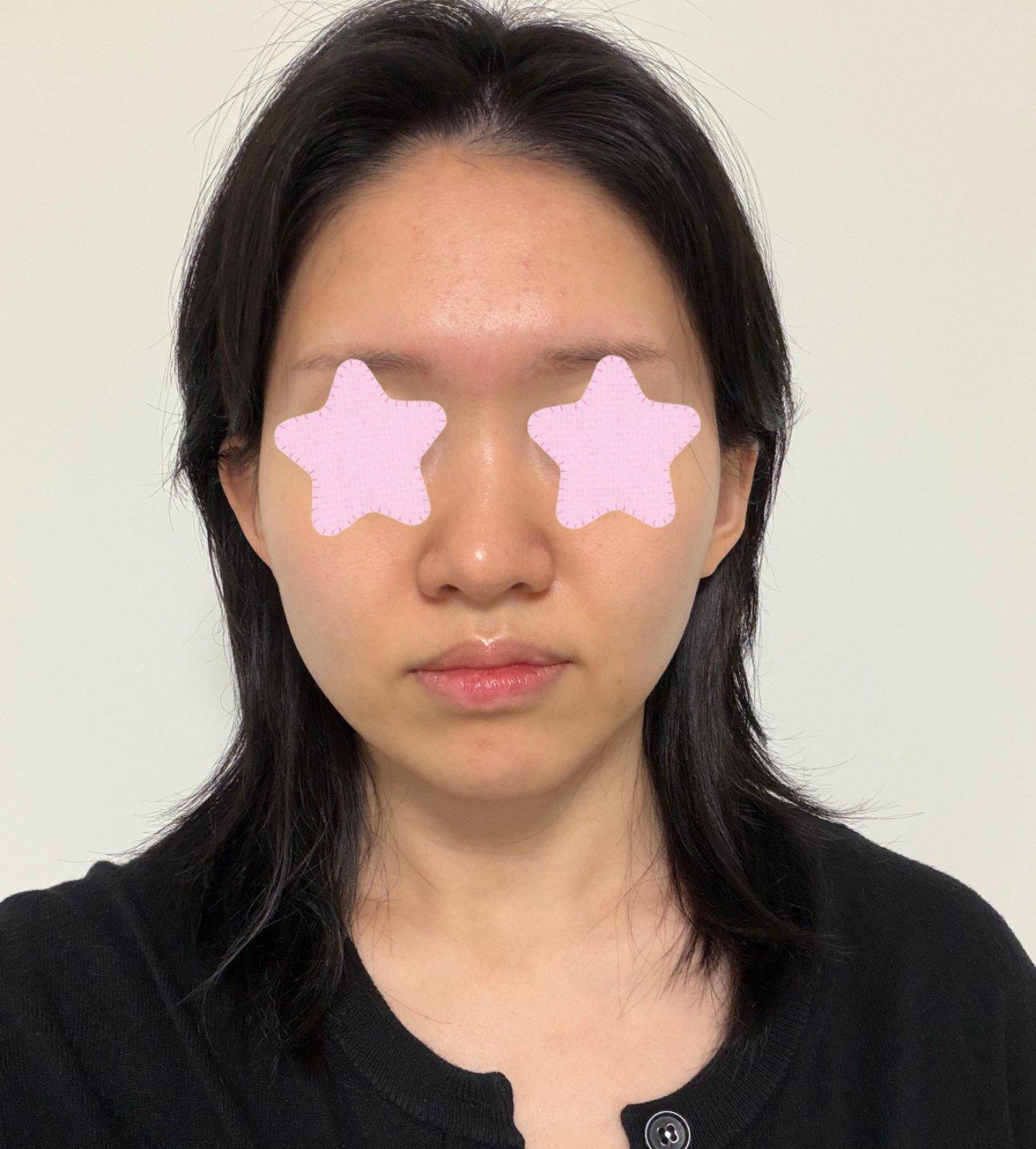 Finally tackled freckles and sun damage with Sciton BBL Hero