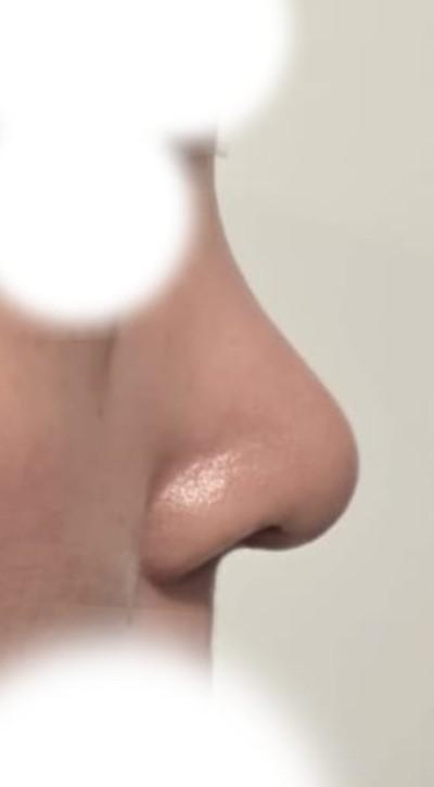 Laser Hair Removal 4