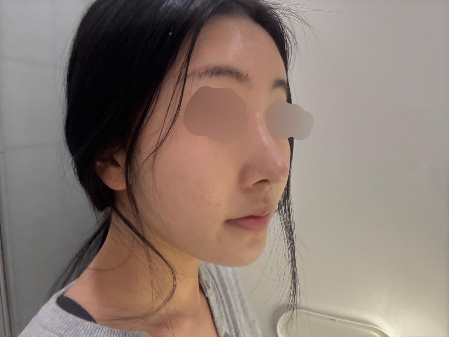 Finally tackled a low bridge and a bulbous tip with Rhinoplasty 7