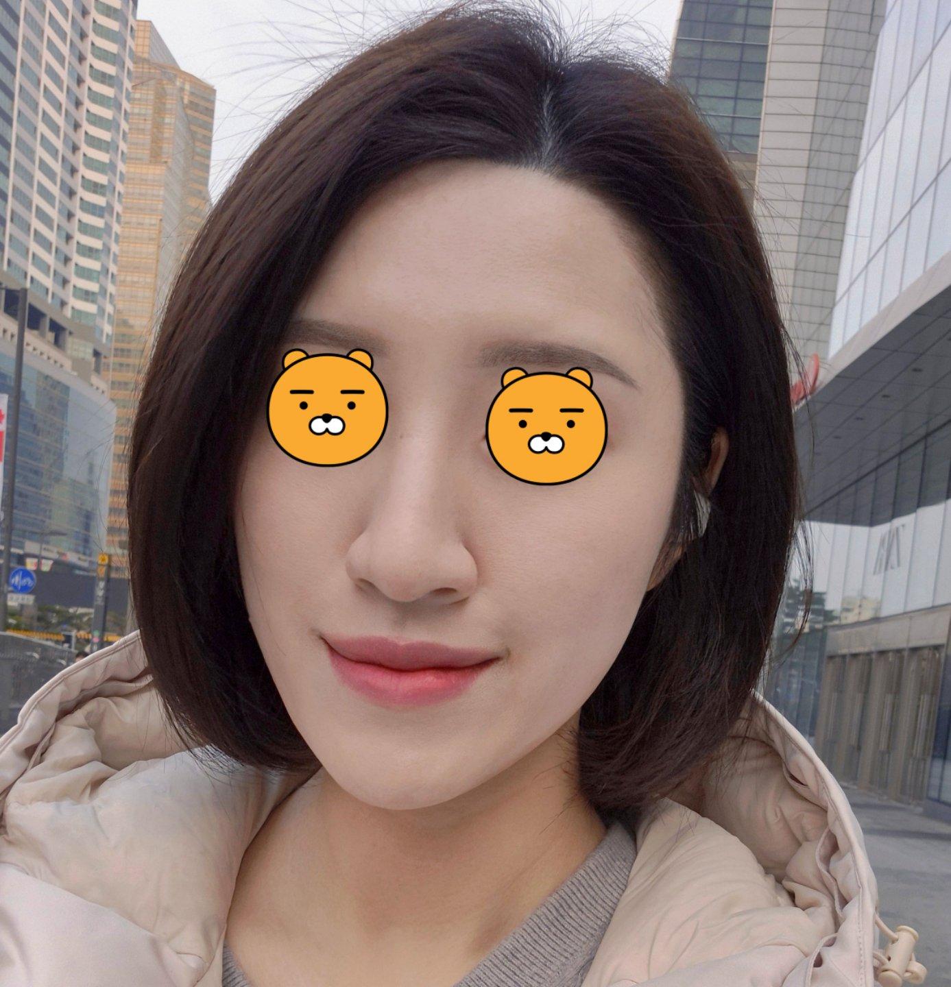 终于对雀斑和光老化动手了——Sciton BBL 宽光谱 5
