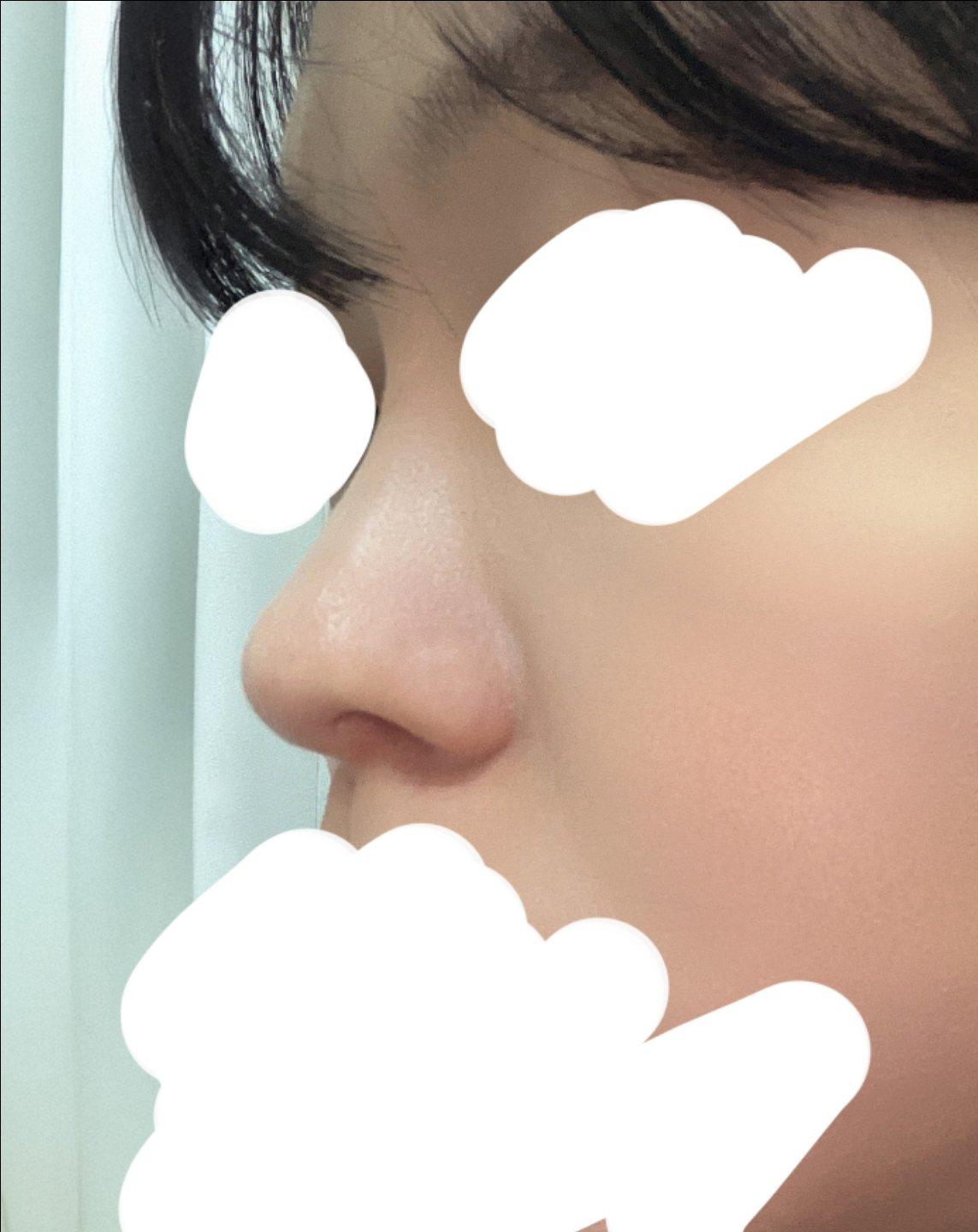 鼻综合整形恢复记录｜鼻梁低、鼻头圆钝终于有救了 3