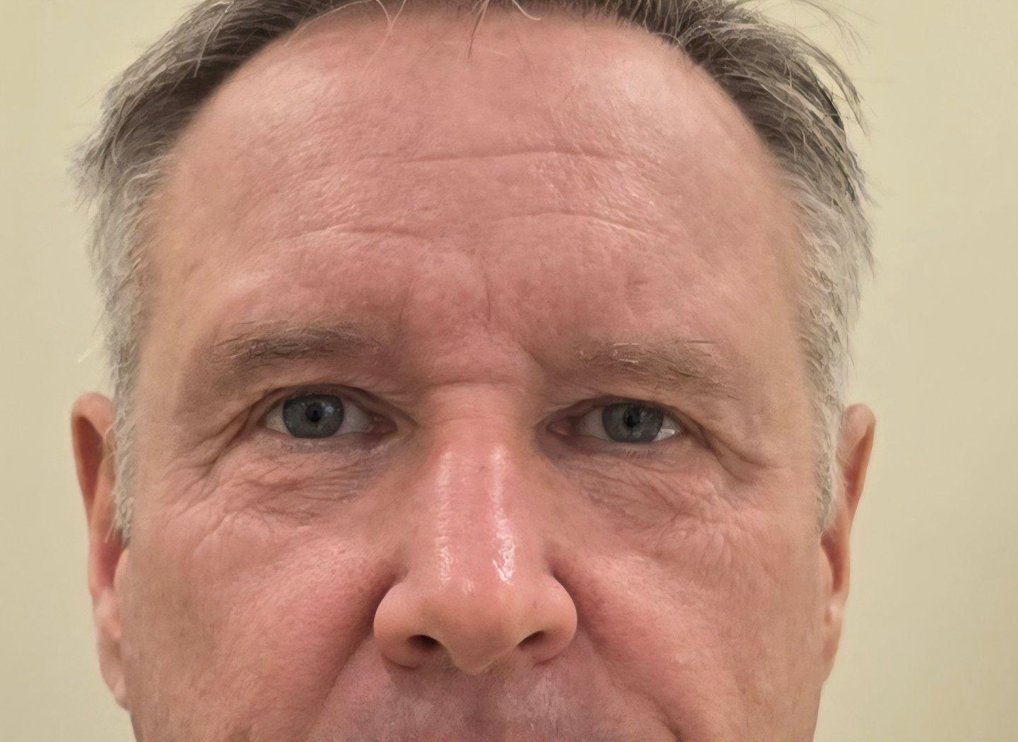 My under-eyes look fresh, no more tired look — so glad I did Lower Blepharoplasty 1