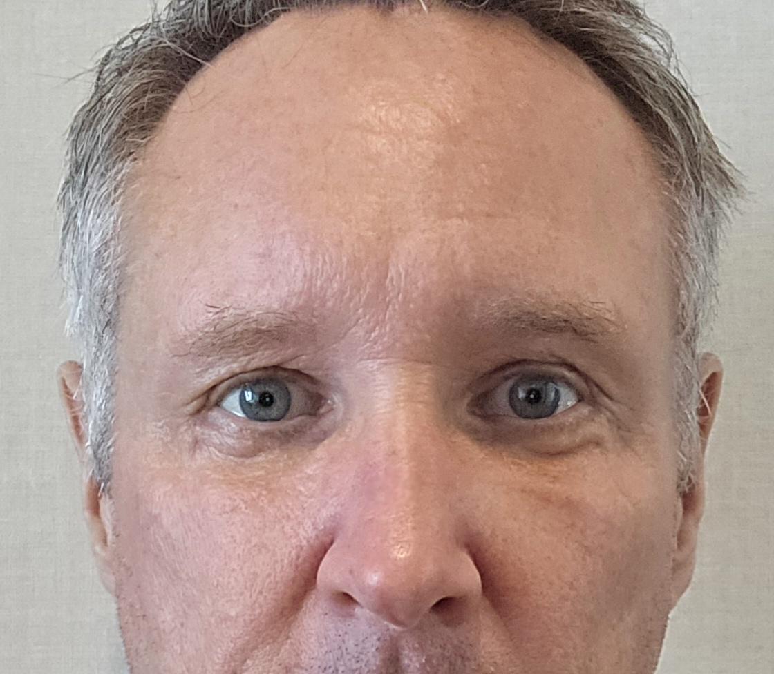 My under-eyes look fresh, no more tired look — so glad I did Lower Blepharoplasty 2