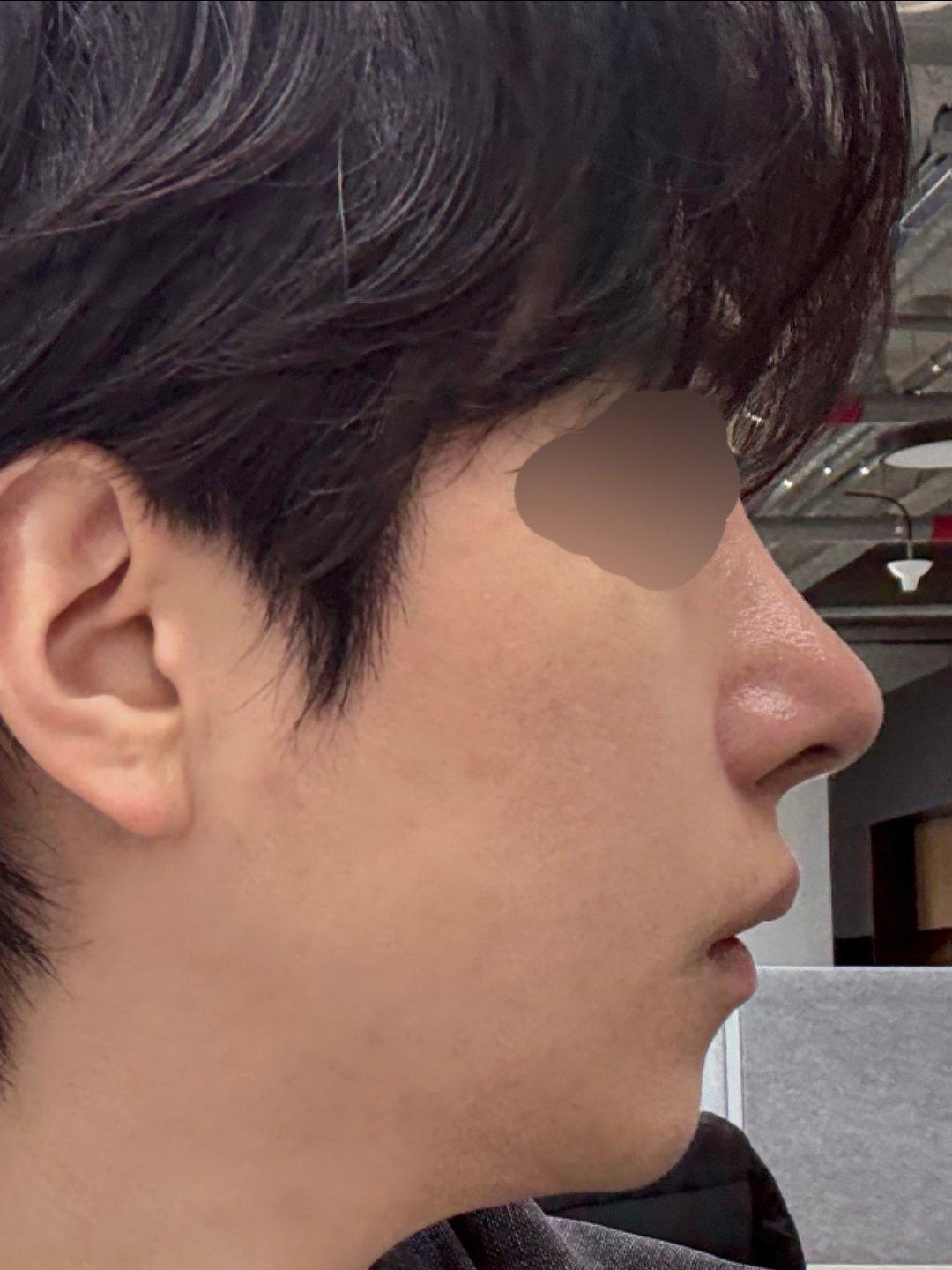 My profile is straight and the tip is refined but natural — so glad I did Rhinoplasty 7