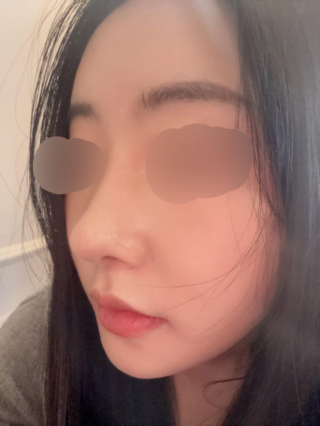 Finally tackled a low bridge and a bulbous tip with Rhinoplasty 9