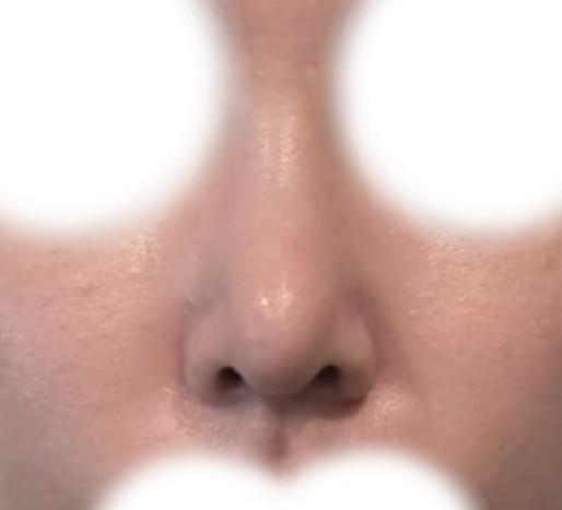 Laser Hair Removal 3