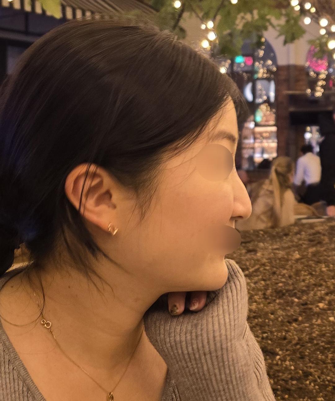My Rhinoplasty experience at FlowMD ✨
