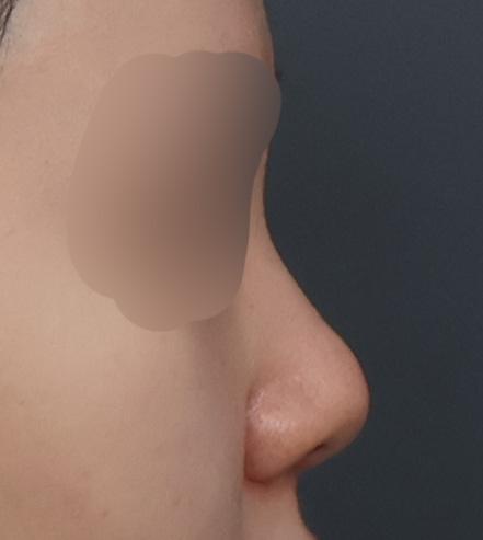 My profile is straight and the tip is refined but natural — so glad I did Rhinoplasty 1