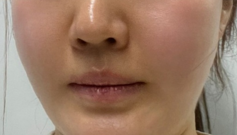 Thermage 热玛吉恢复记录｜皮肤松弛、轮廓模糊终于有救了 3
