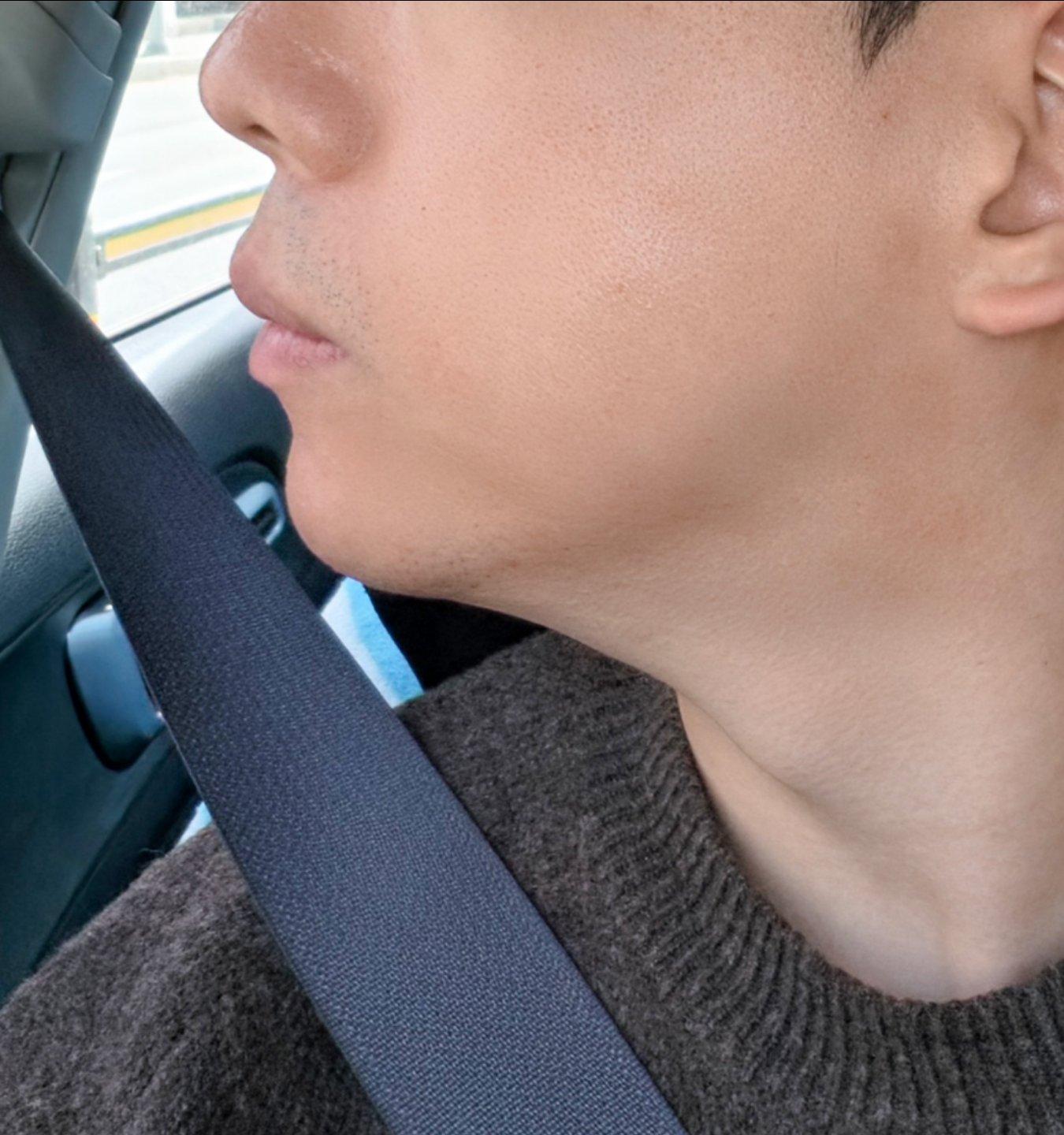 Chin Implant 6