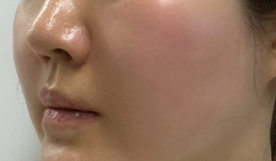 Thermage 热玛吉恢复记录｜皮肤松弛、轮廓模糊终于有救了 4