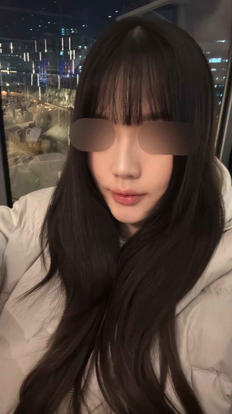 A few weeks after Rhinoplasty 🙌 2
