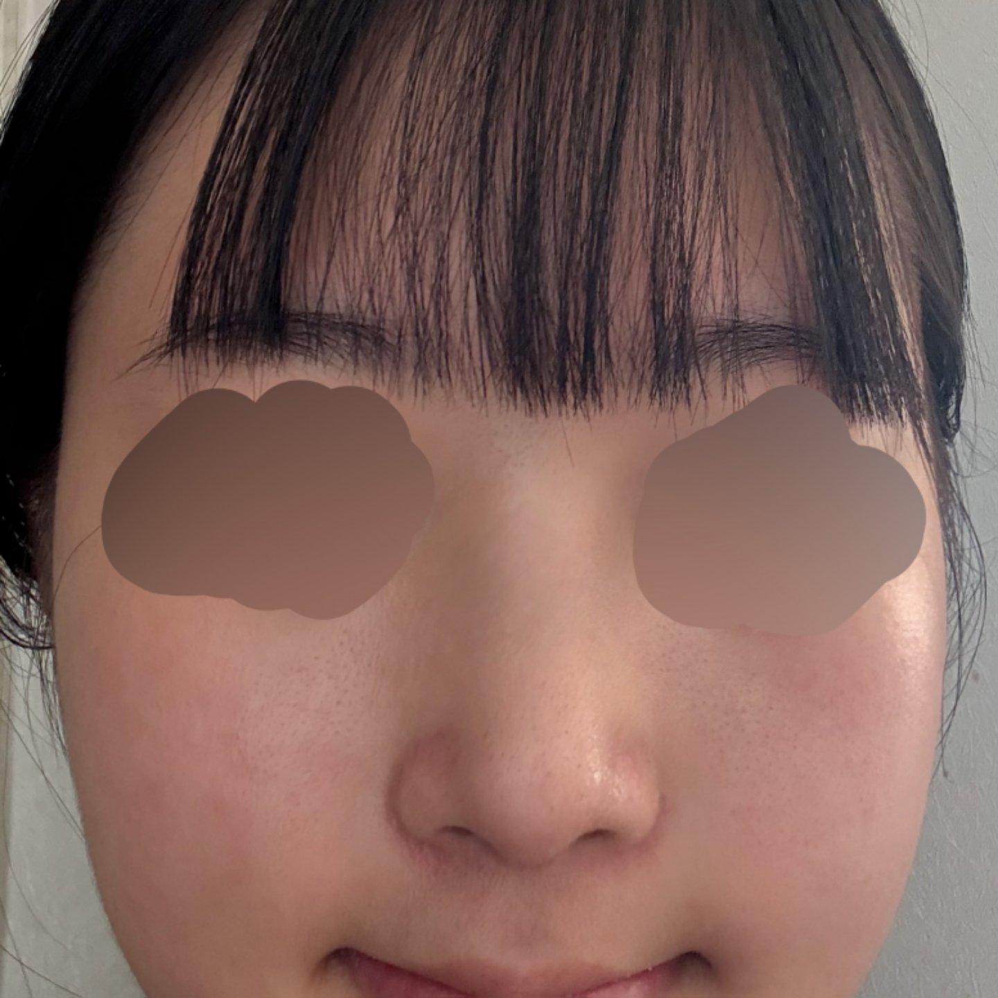 My profile is straight and the tip is refined but natural — so glad I did Rhinoplasty 7
