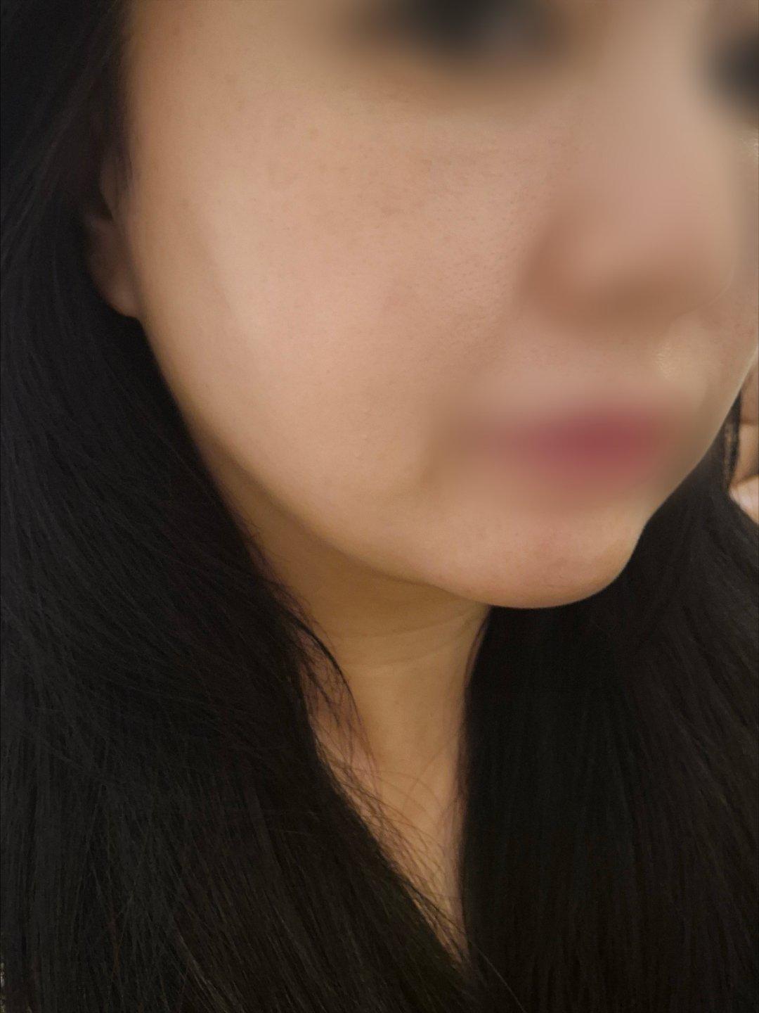 终于对眉眼和下颌下垂动手了——Ultherapy 超声提升 6
