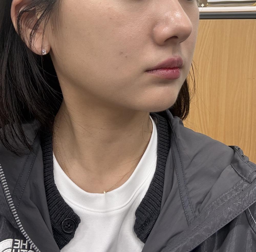 终于对面部凹陷、显憔悴动手了——Sculptra 童颜针 3