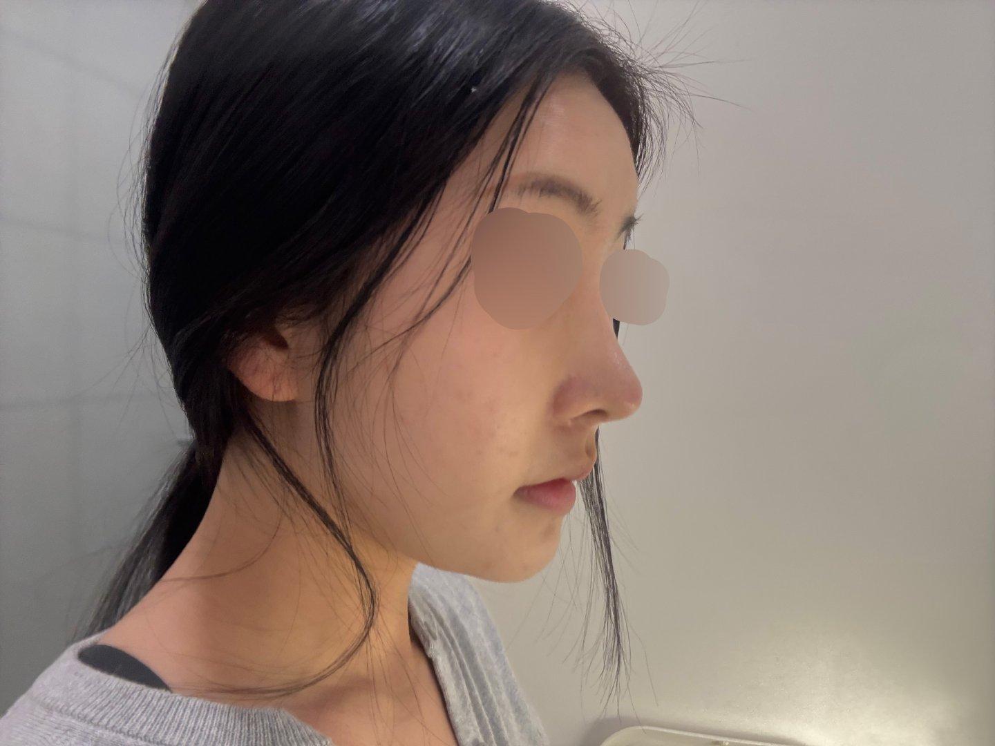Finally tackled a low bridge and a bulbous tip with Rhinoplasty 8