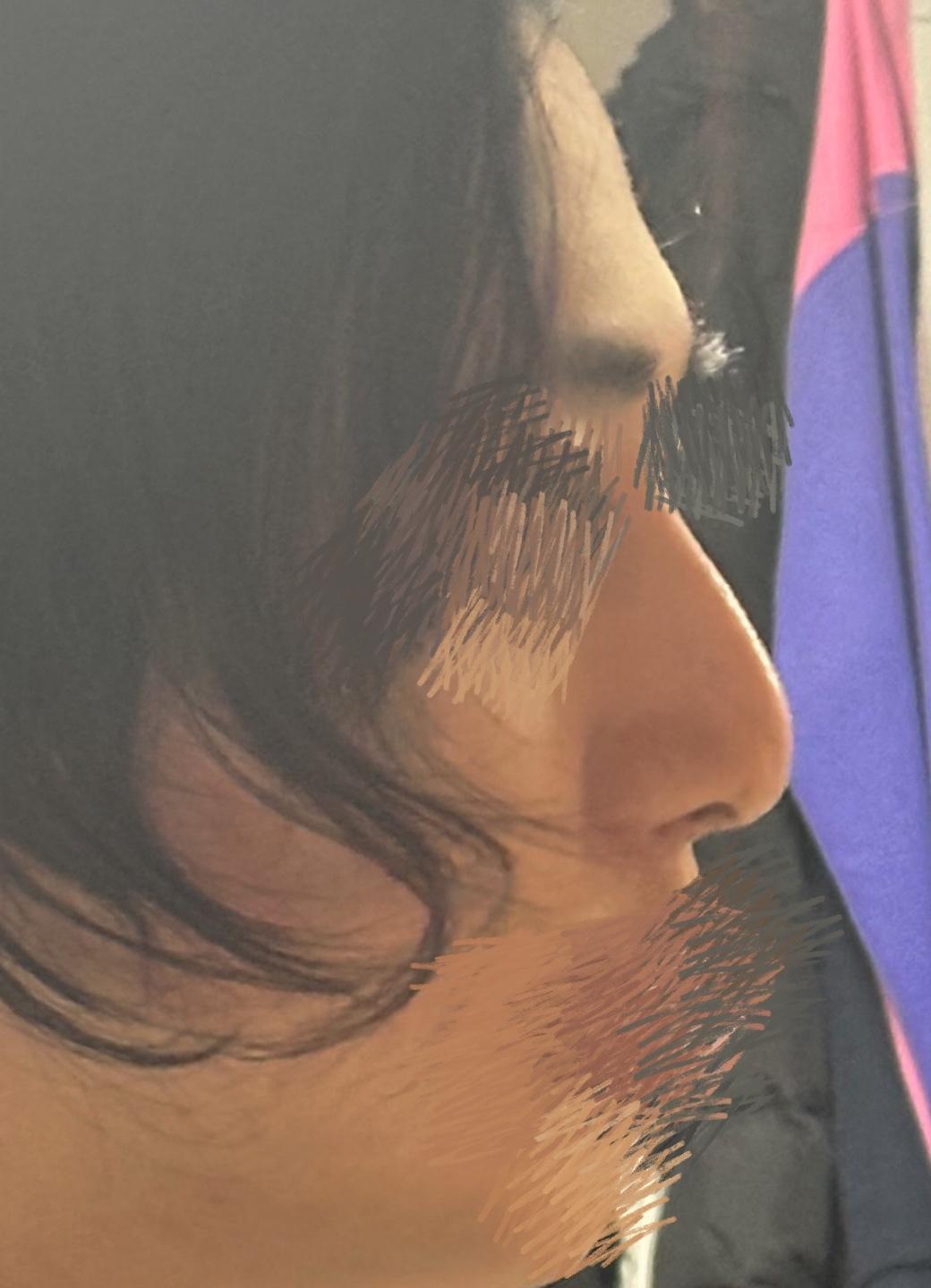 My profile is straight and the tip is refined but natural — so glad I did Rhinoplasty 2