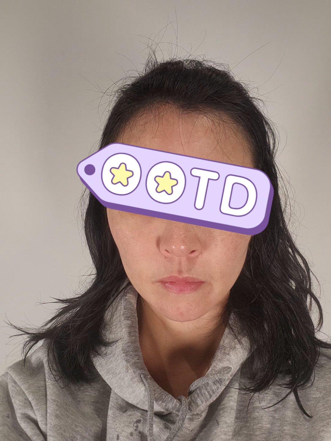 终于对抬头纹和川字纹动手了——Dysport 丽舒妥