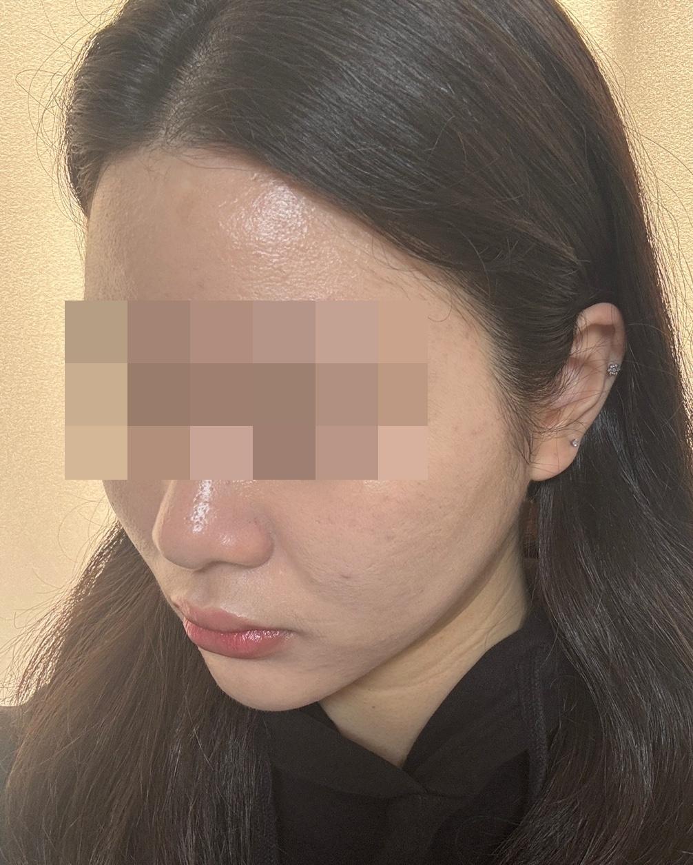 在 FlowMD 做了Ultherapy 超声提升，真实分享✨ 2