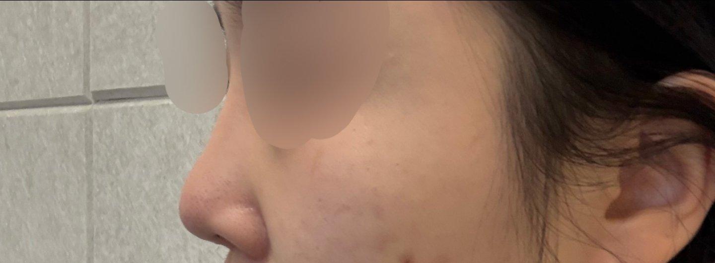 Finally tackled a low bridge and a bulbous tip with Rhinoplasty 4