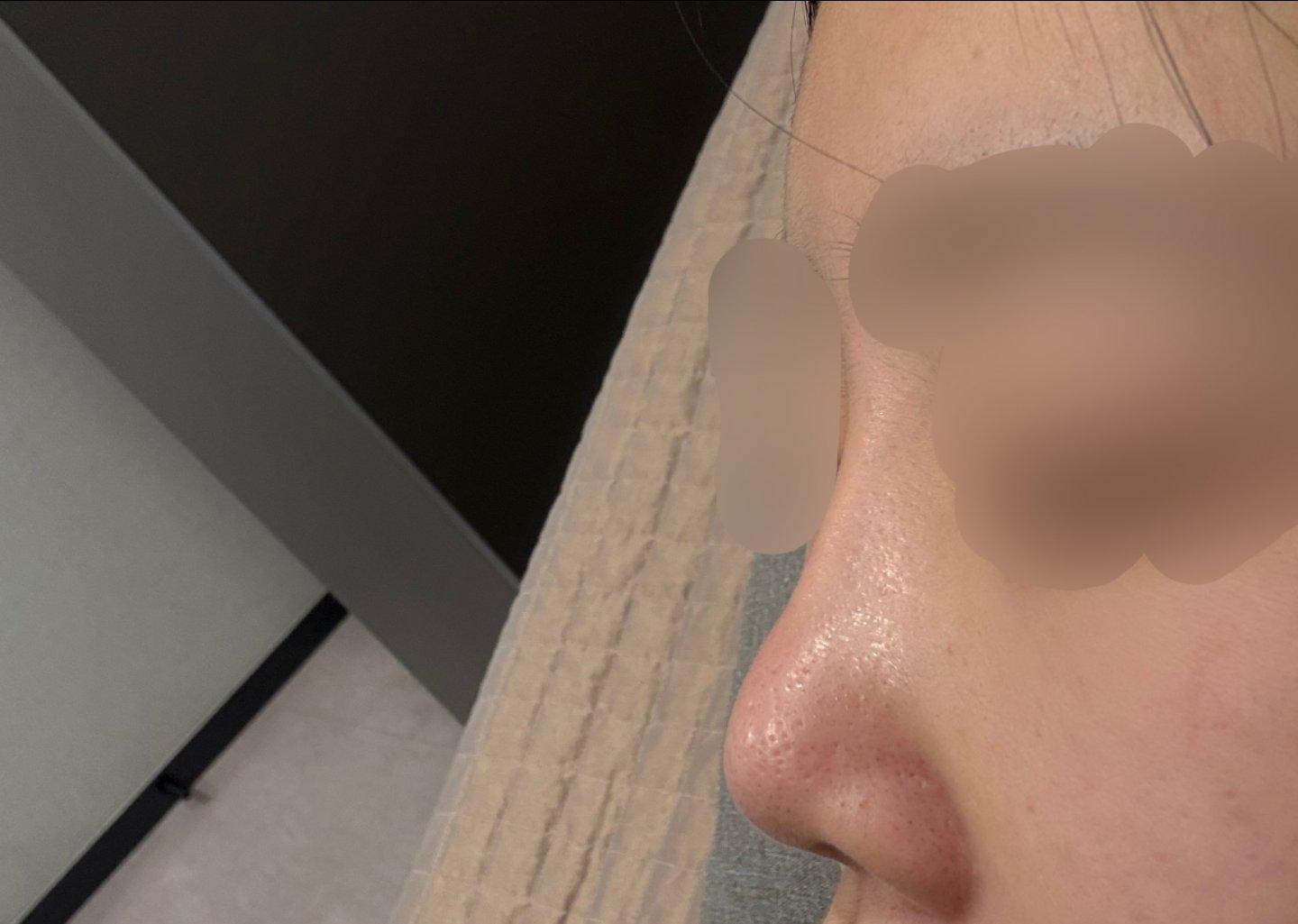Finally tackled a low bridge and a bulbous tip with Rhinoplasty 1