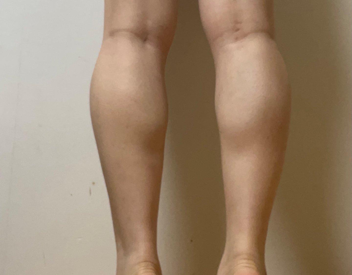 I can actually see some ab definition — so glad I did Emsculpt NEO 2