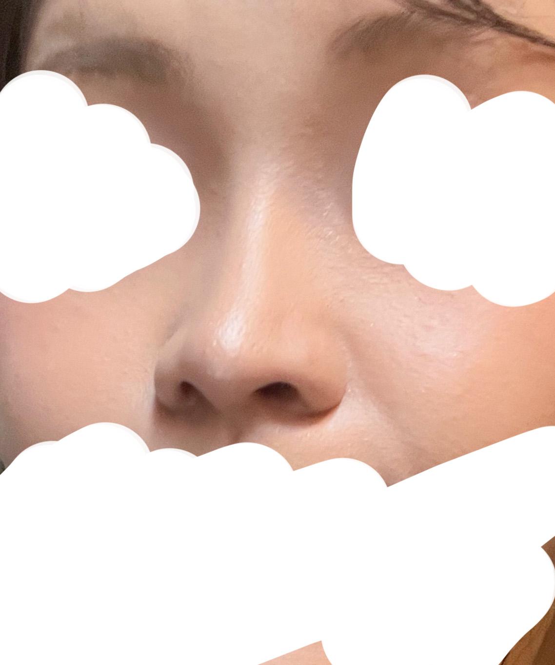 鼻综合整形恢复记录｜鼻梁低、鼻头圆钝终于有救了 1