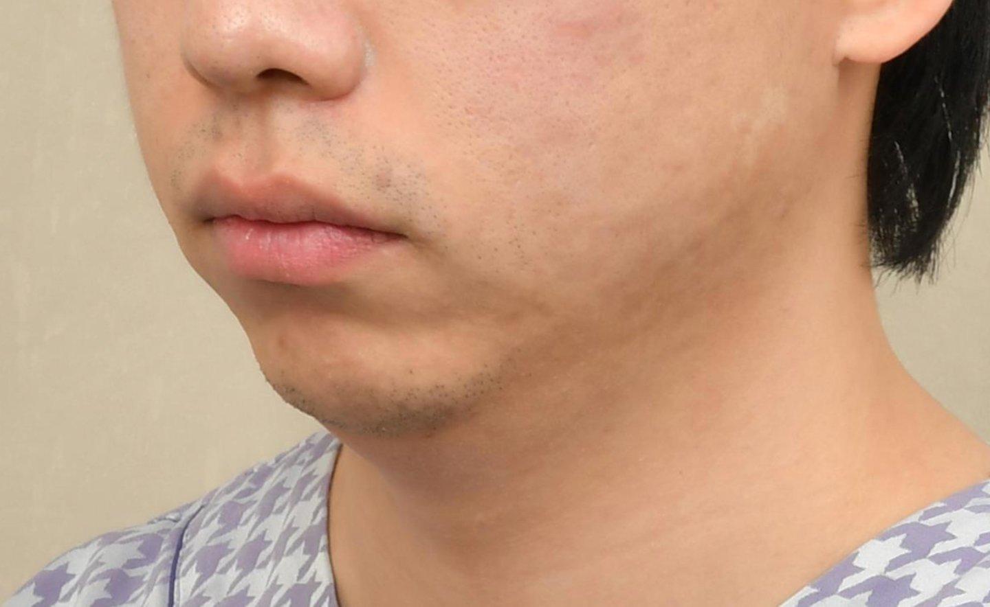 Chin Implant