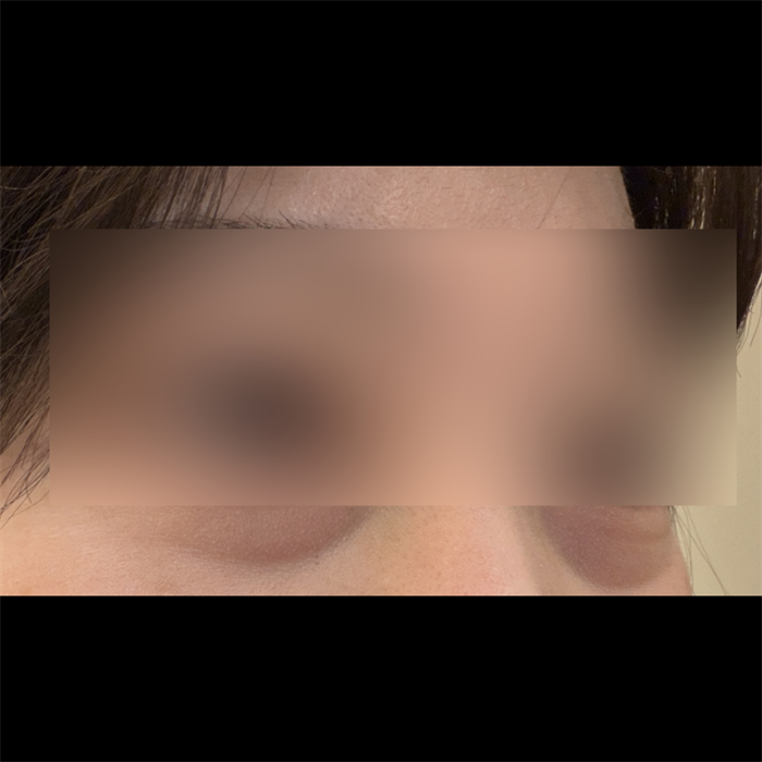 My under-eyes look fresh, no more tired look — so glad I did Lower Blepharoplasty 1