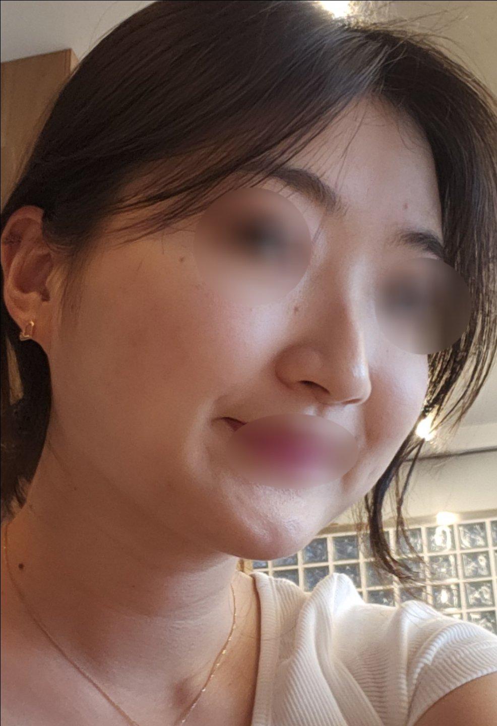 My Rhinoplasty experience at FlowMD ✨ 3
