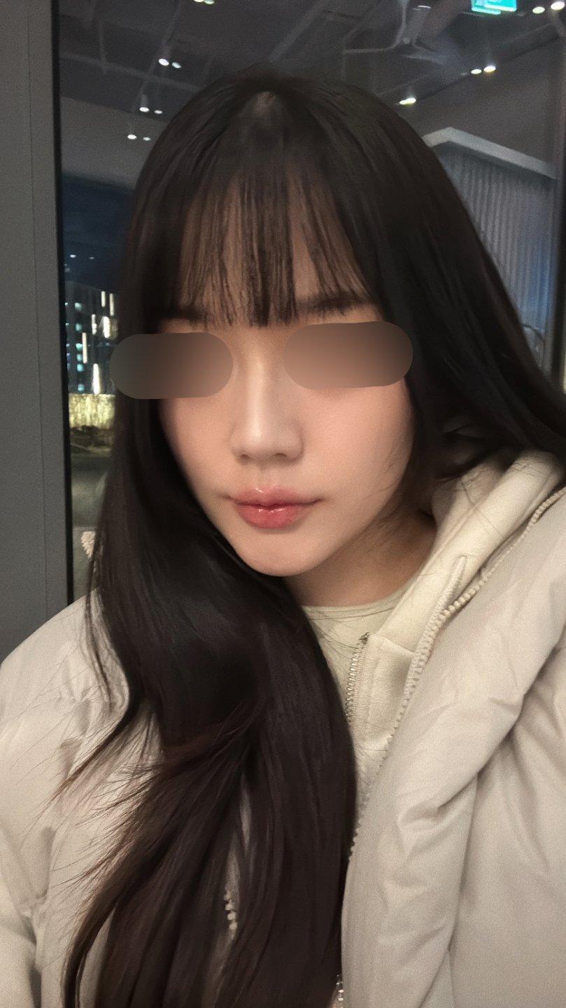 A few weeks after Rhinoplasty 🙌 1