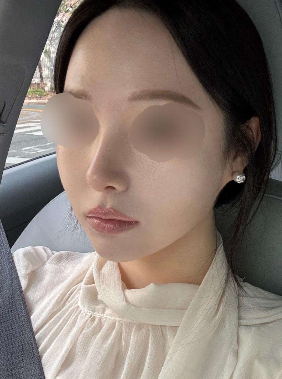 My profile is straight and the tip is refined but natural — so glad I did Rhinoplasty 4