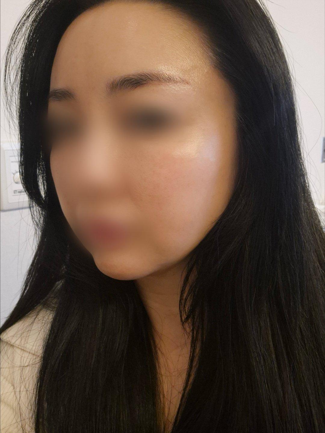 终于对眉眼和下颌下垂动手了——Ultherapy 超声提升 4