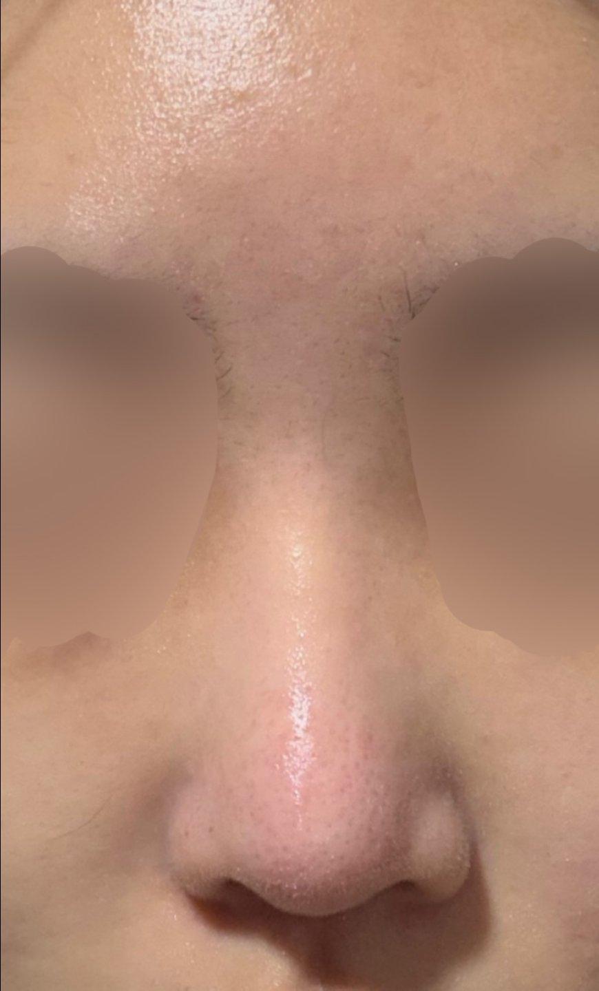 Finally tackled a low bridge and a bulbous tip with Rhinoplasty 5