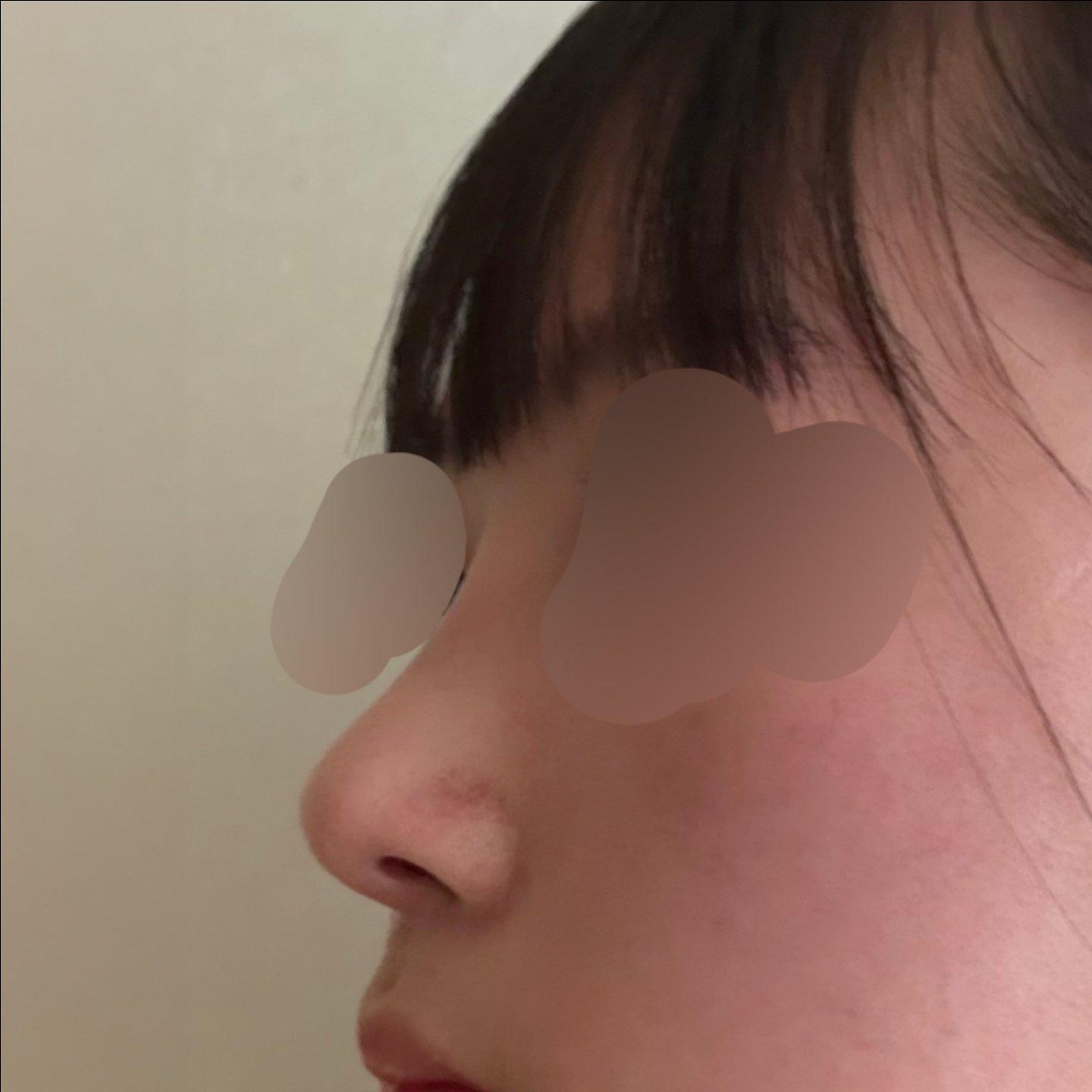 My profile is straight and the tip is refined but natural — so glad I did Rhinoplasty 8