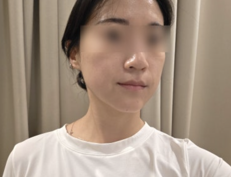 My smile lines softened and my jaw looks tighter — so glad I did Fotona 4D 2