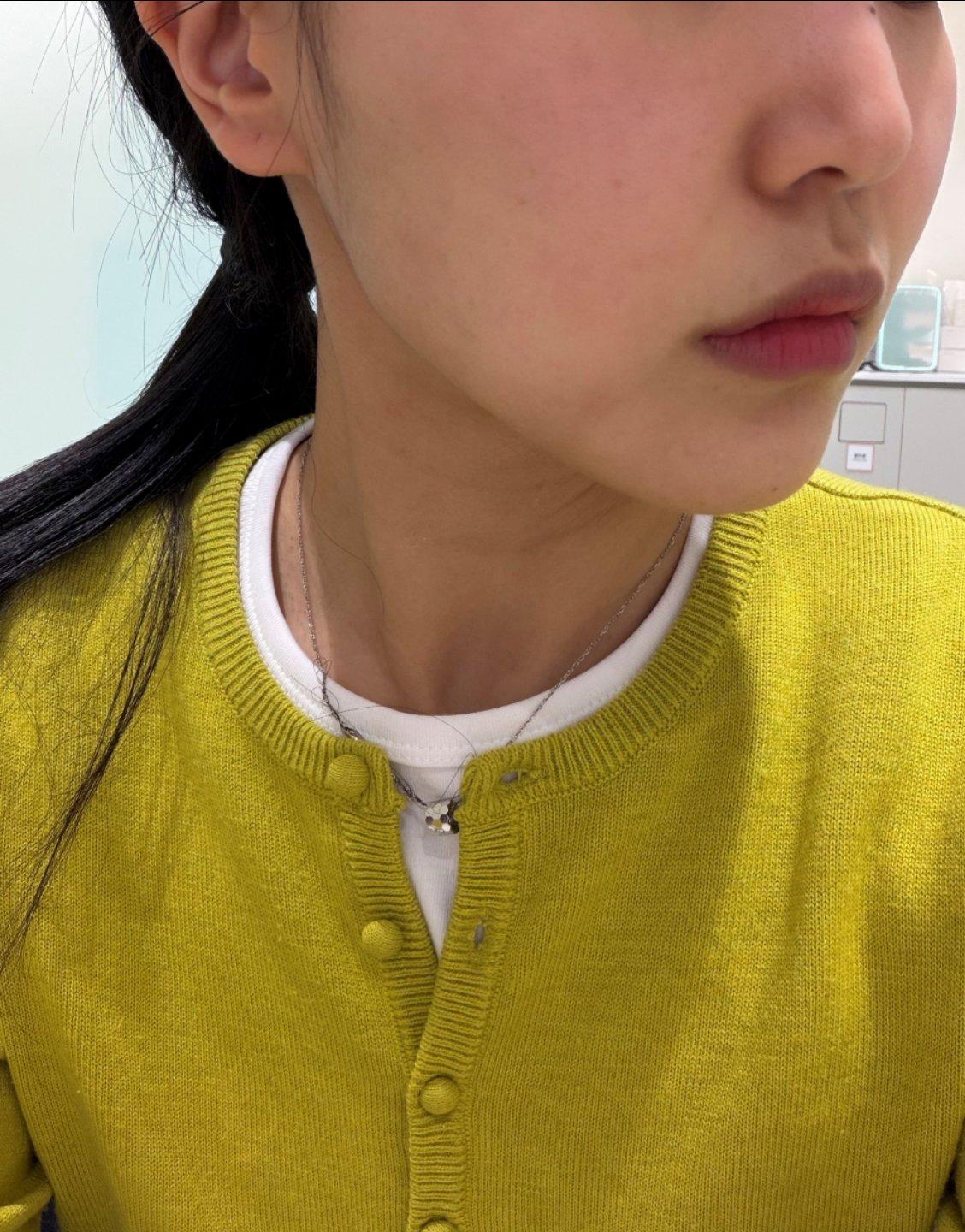 FaceTite 黄金微雕术后几周，下颌线紧致，恢复还很快🙌 3