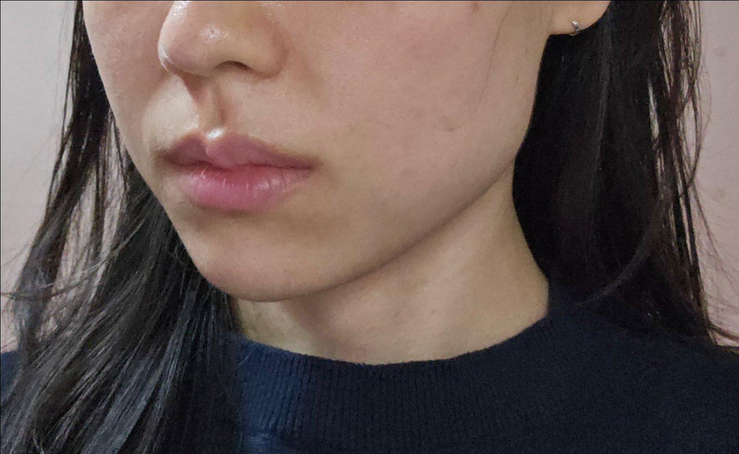 Finally tackled nasolabial folds and early jowls with Fotona 4D 2