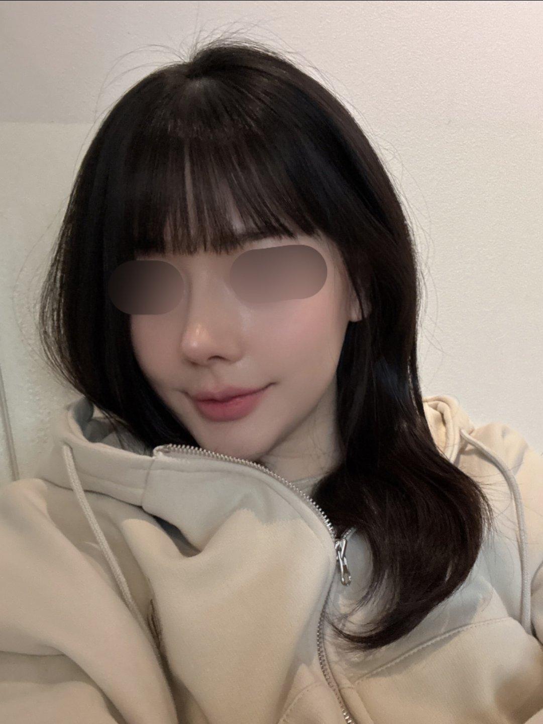 A few weeks after Rhinoplasty 🙌 5