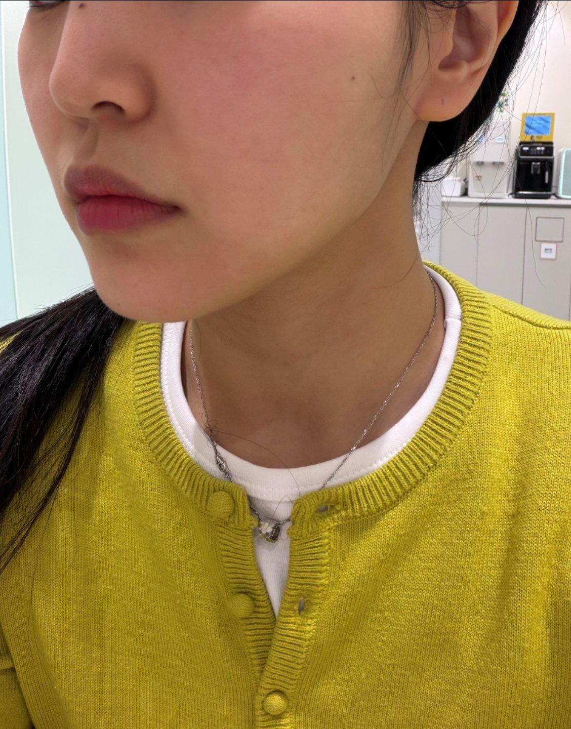 FaceTite 黄金微雕术后几周，下颌线紧致，恢复还很快🙌 1