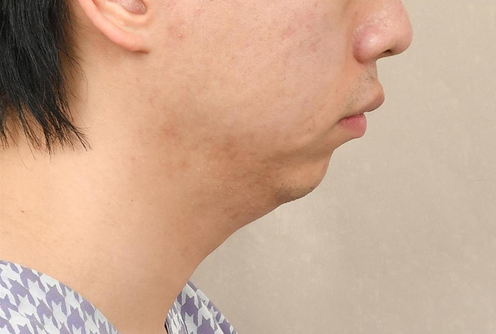 Chin Implant 2