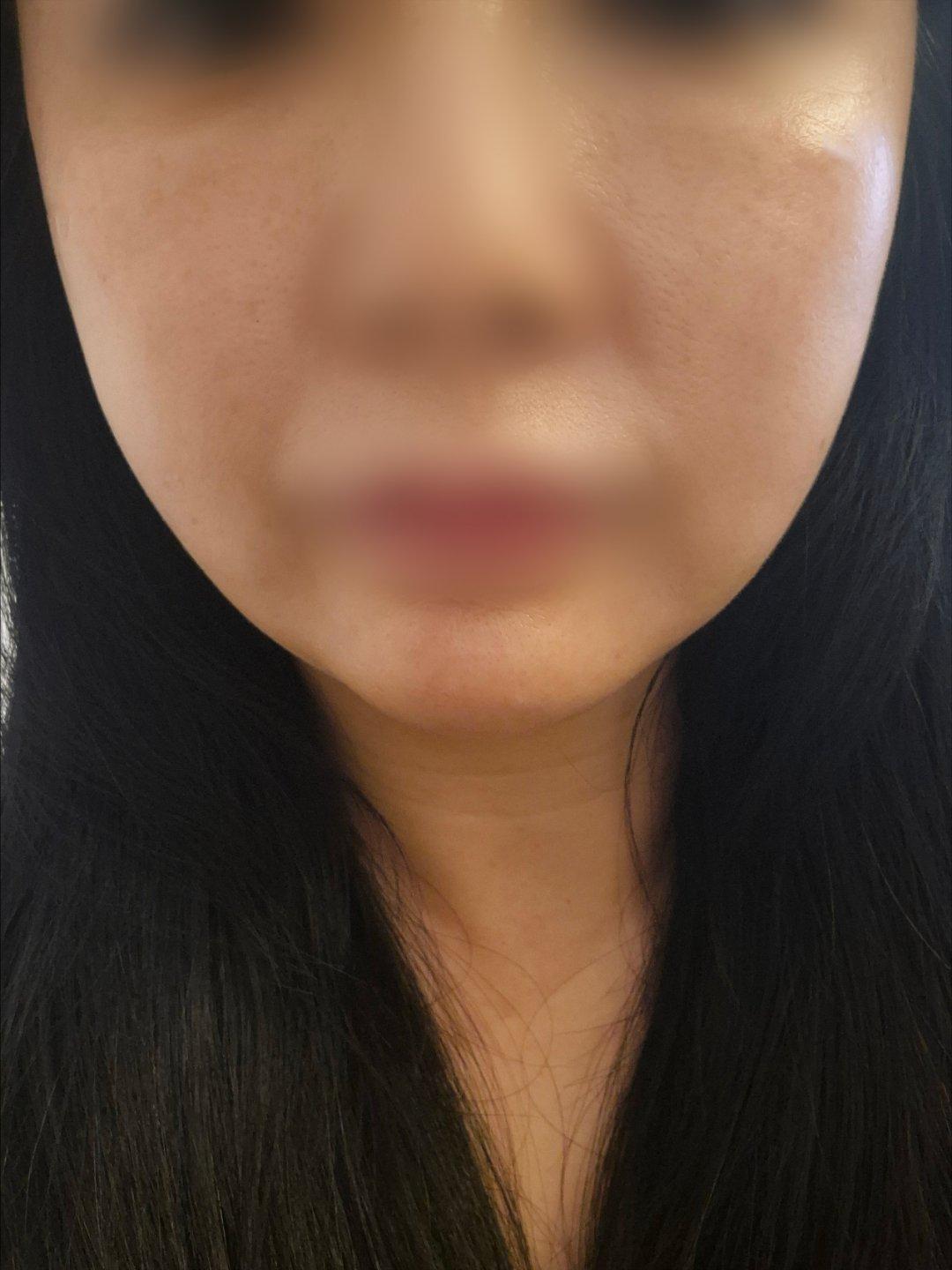 终于对眉眼和下颌下垂动手了——Ultherapy 超声提升
