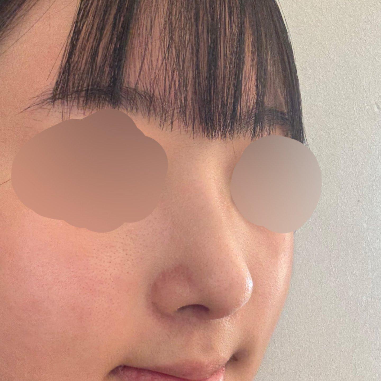 My profile is straight and the tip is refined but natural — so glad I did Rhinoplasty 6