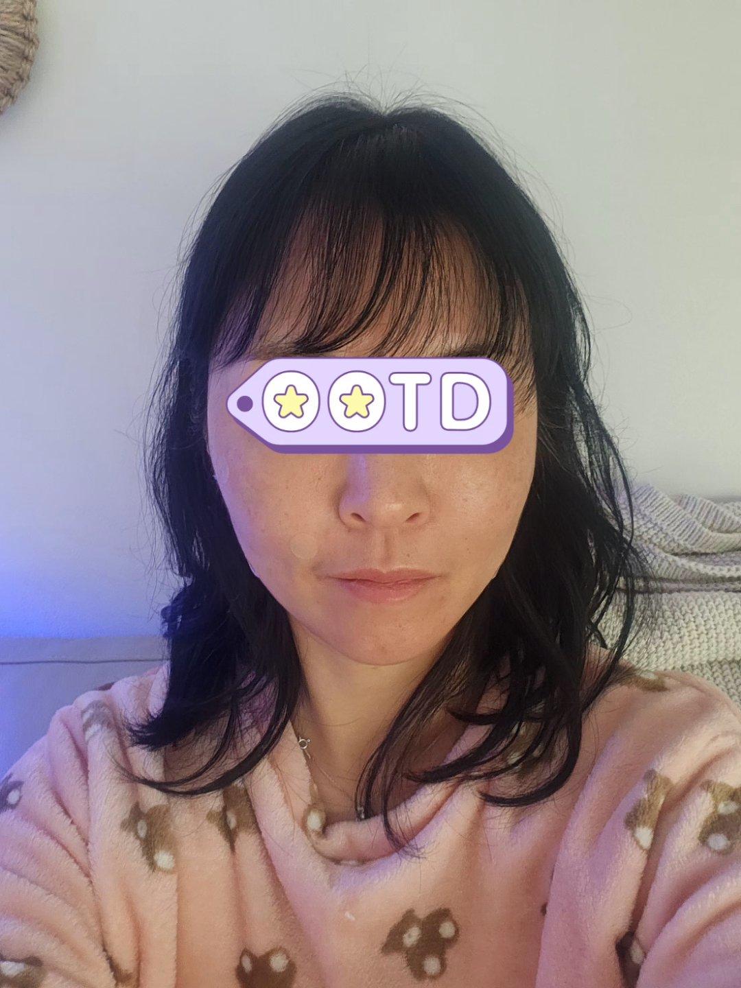 终于对抬头纹和川字纹动手了——Dysport 丽舒妥 5