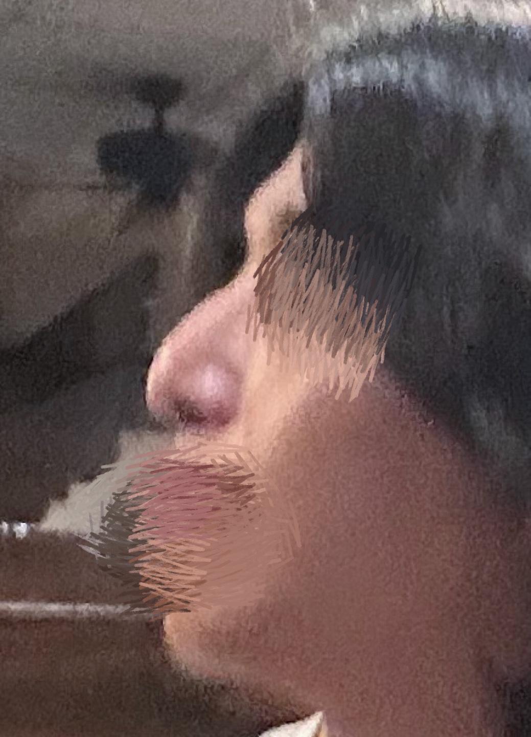 My profile is straight and the tip is refined but natural — so glad I did Rhinoplasty
