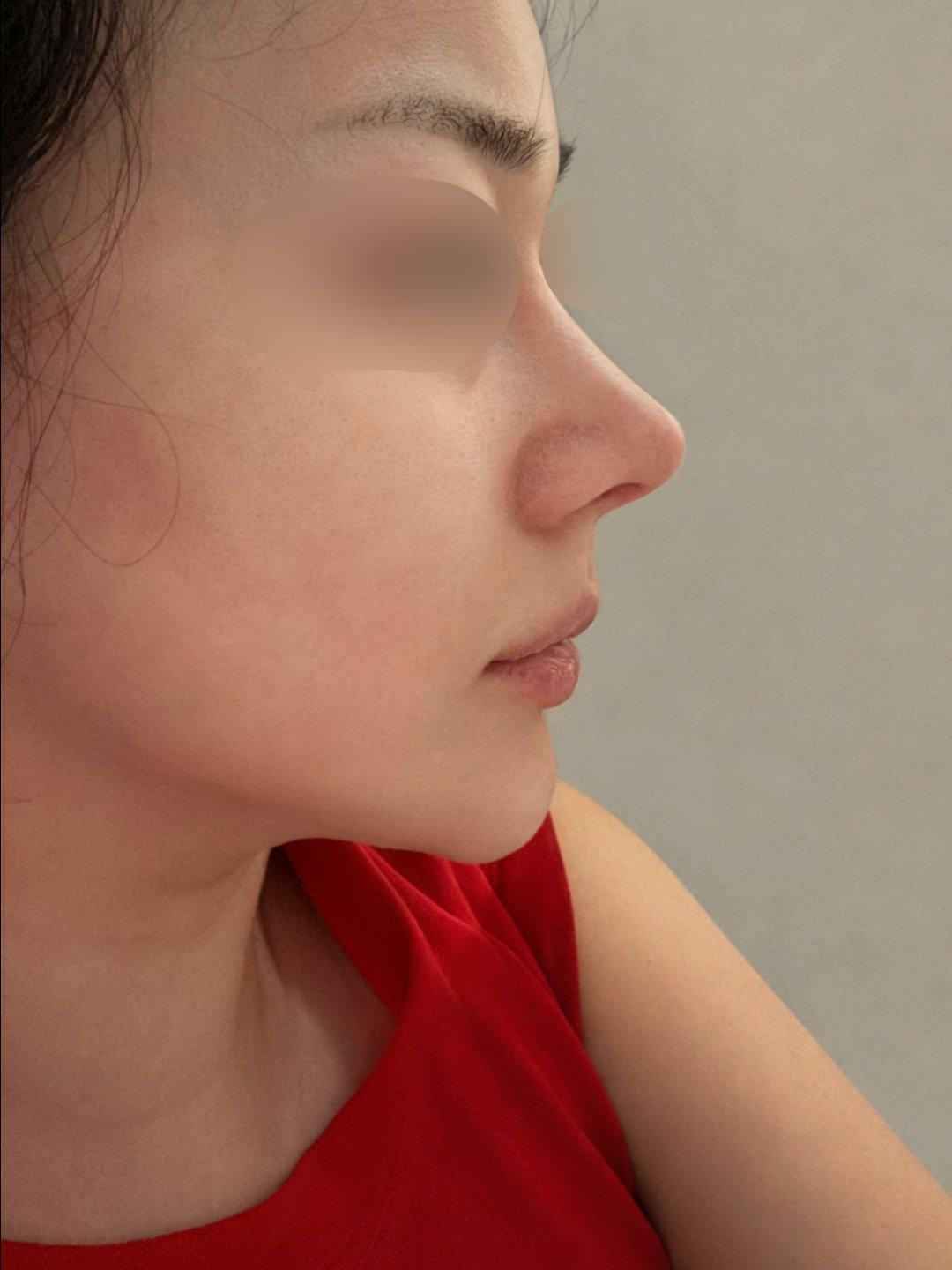 A few weeks after Rhinoplasty 🙌 6