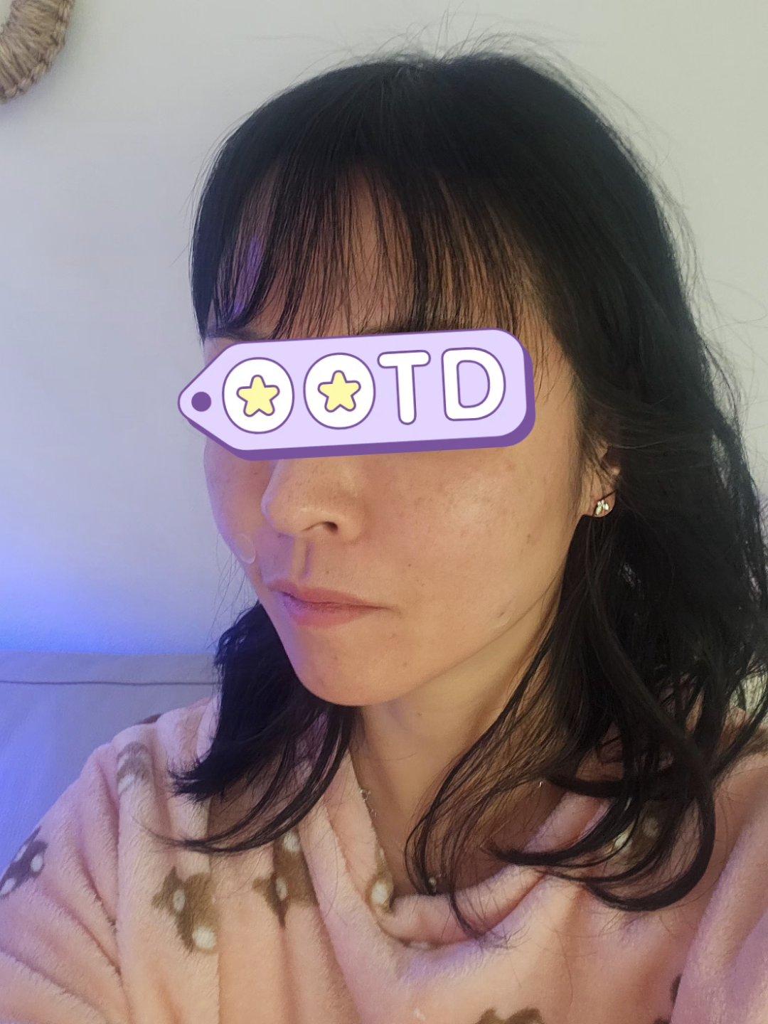 终于对抬头纹和川字纹动手了——Dysport 丽舒妥 6