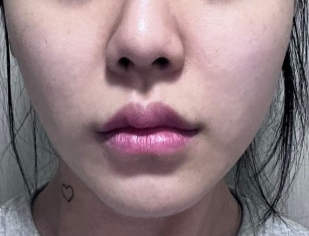 Thermage 热玛吉术后几周，脸明显提拉，还没有恢复期🙌 2