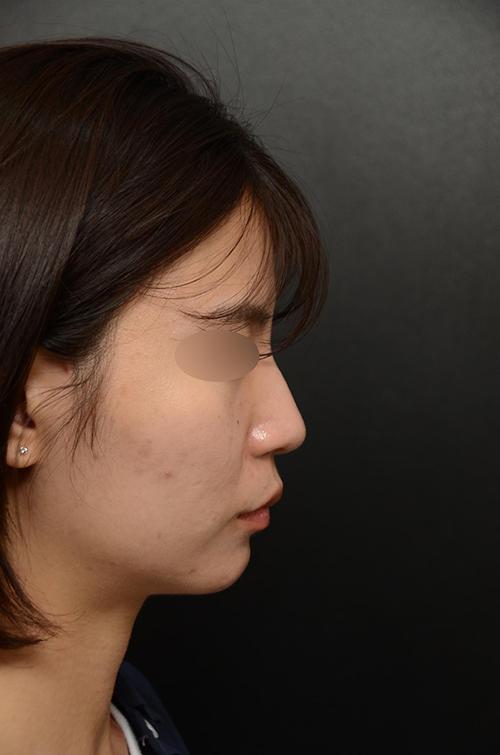 My Rhinoplasty experience at FlowMD ✨ 3